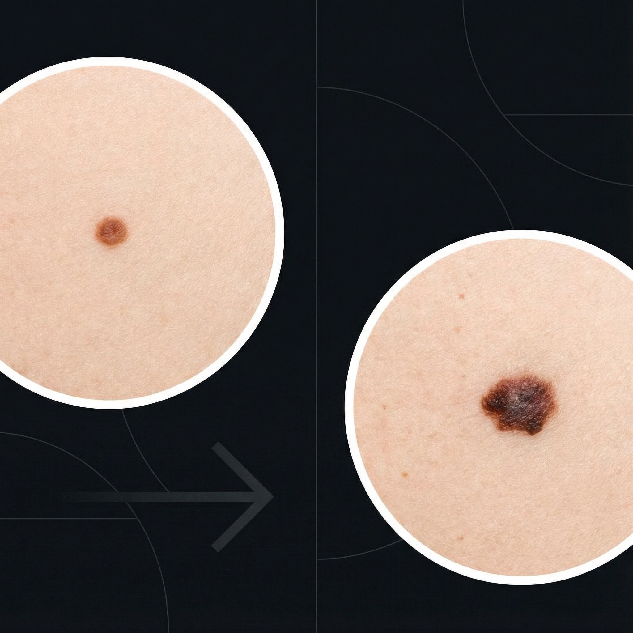 A close-up of skin showing a new mole or spot that is growing larger over time. Informational style, modern layout, high contrast. aspect ratio 1:1, no visible text, no Korean text